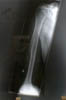 Final X-ray from 2nd January - new bone visible either side of the fracture