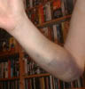 The lower arm was quite bruised and swollen, though not painful